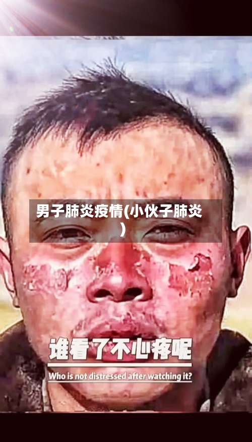 男子肺炎疫情(小伙子肺炎)-第3张图片